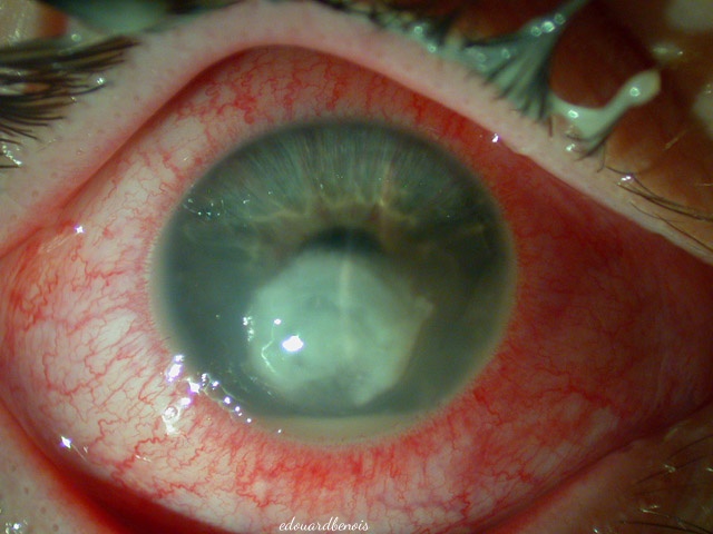 kornea absceso sub kontakta lenso