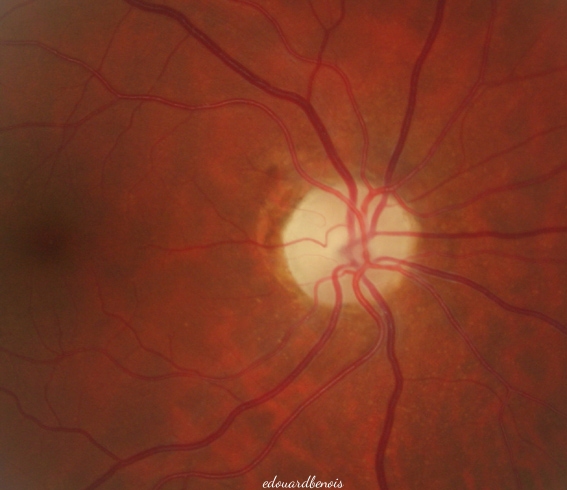 atrofio de oftalma nervo