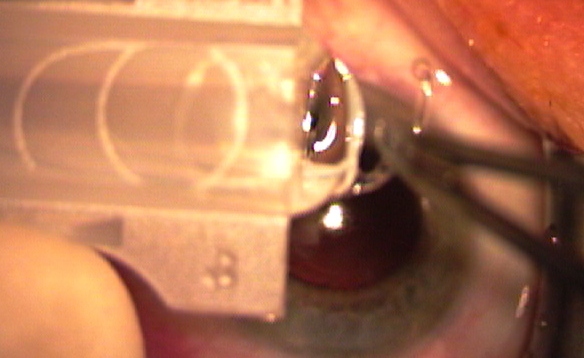 insertion du cristallin artificiel dans la cartouche de l'injecteur
