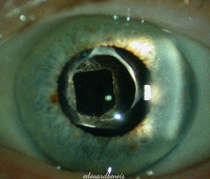 cataracte secondaire opérée au laser YAG