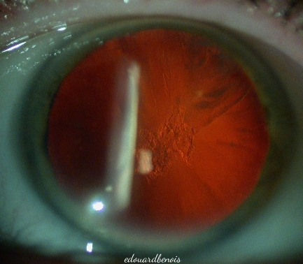 cataracte sous-capsulaire postérieure