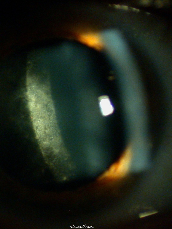 cataracte sous-capsulaire postérieure