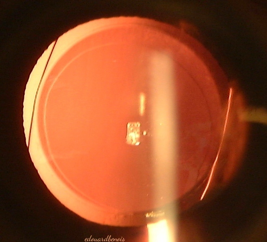 cristallin artificiel en silicone