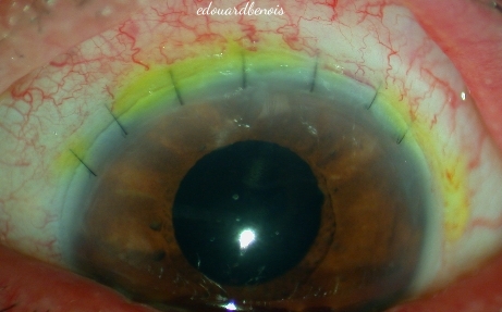 extraction extra-capsulaire manuelle de la cataracte