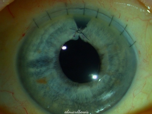 extraction extra-capsulaire manuelle de la cataracte