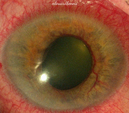 neovaskula glaukomo