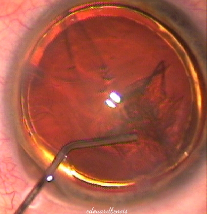 hydrodissection de la cataracte