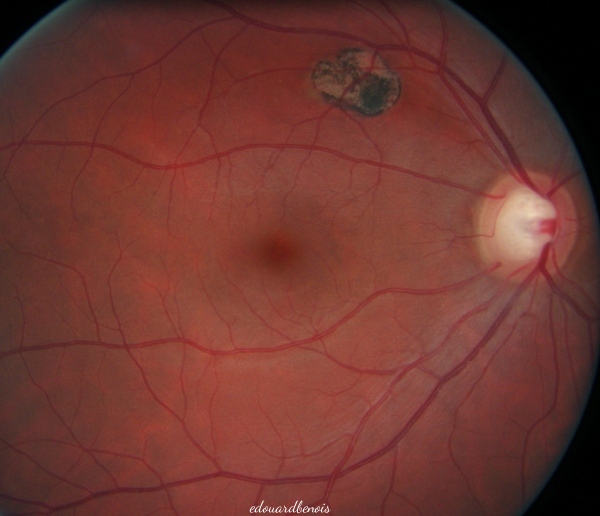 hiperplazio de la pigmenta retina epitelio