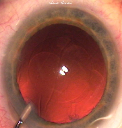 injection de hyaluronate dans la chambre antérieure de l'œil