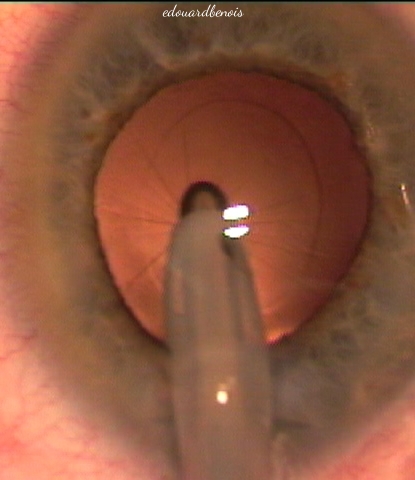 nettoyage de la capsule postérieure de la cataracte