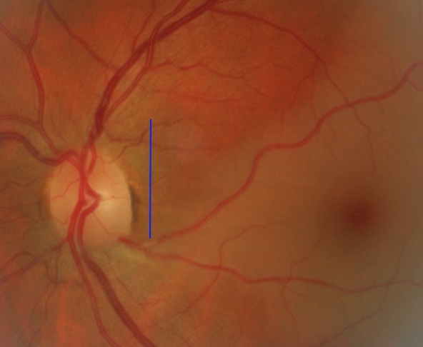 occlusion d'une artère ciliorétinienne de l'œil gauche