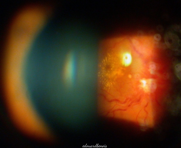 retina edema vejna okluzio