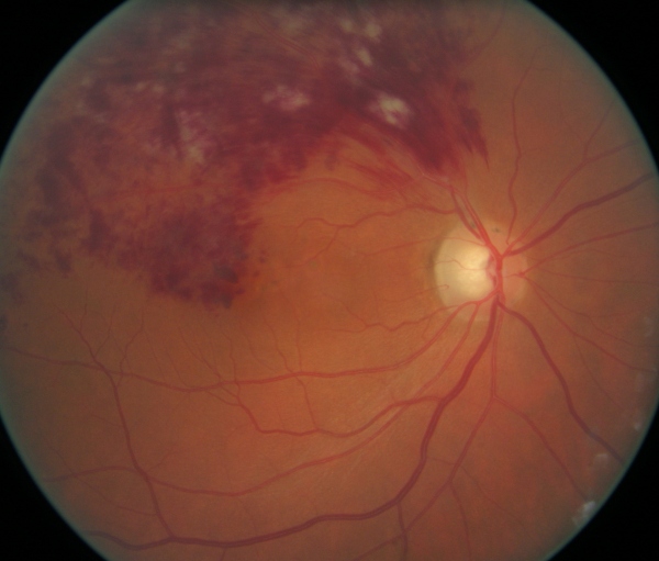 retina vejna parta okluzio