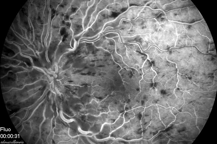 retina hemoragia vejna okluzio