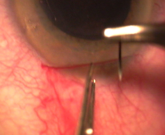 suture incision de cornée