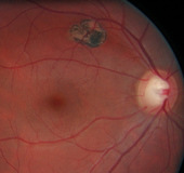 ligilo al hiperplazio de la pigmenta retina epitelio