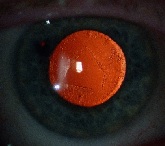 lien vers découpe au laser YAG de cataracte secondaire