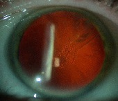 lien vers cataracte sous-capsulaire postérieure