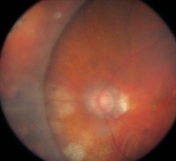 ligilo al endentigo retino alsklerota