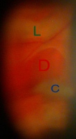 ligilo al retina deŝiro ĵus laserigita