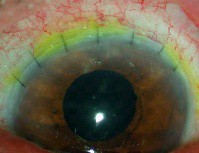 lien vers extraction extra-capsulaire manuelle de la cataracte