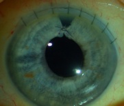 lien vers extraction extra-capsulaire manuelle de la cataracte
