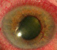 ligilo al neovaskula glaukomo