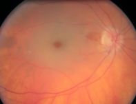 ligilo al okludo de la retina centra arterieto