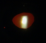 ligilo al iridomio per lasero