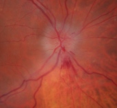 ligilo al infarkto de la opta nervo