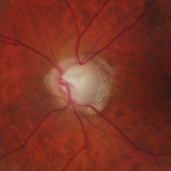 lien vers papille optique glaucomateuse
