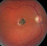 lien vers toxoplasmose oculaire